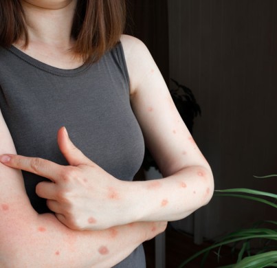 Tout ce que vous devez savoir sur la mpox