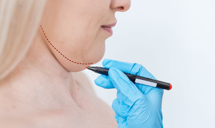 Neck Liposuction Vs. Neck Lift: What's The Difference?