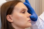 Les étapes de la rhinoplastie (chirurgie esthétique du nez) en Turquie