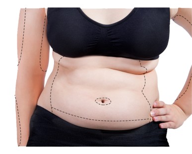 Chirurgie bariatrique : combien de poids vais-je perdre ?