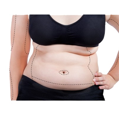 Bariatric Surgery: How Much Weight Will I Lose?