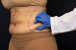 Plastic Surgery After Weight Loss: What are the Options?