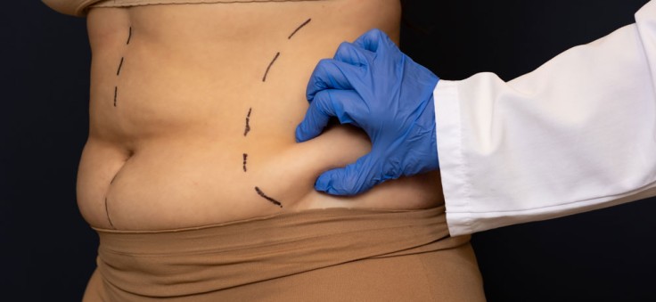 Plastische Chirurgie nach Gewichtsverlust: Welche Möglichkeiten gibt es?