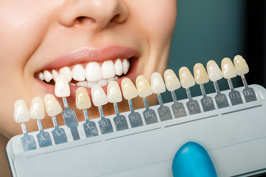 Porzellan Veneers vs. Zirkonkronen: Was ist der Unterschied?