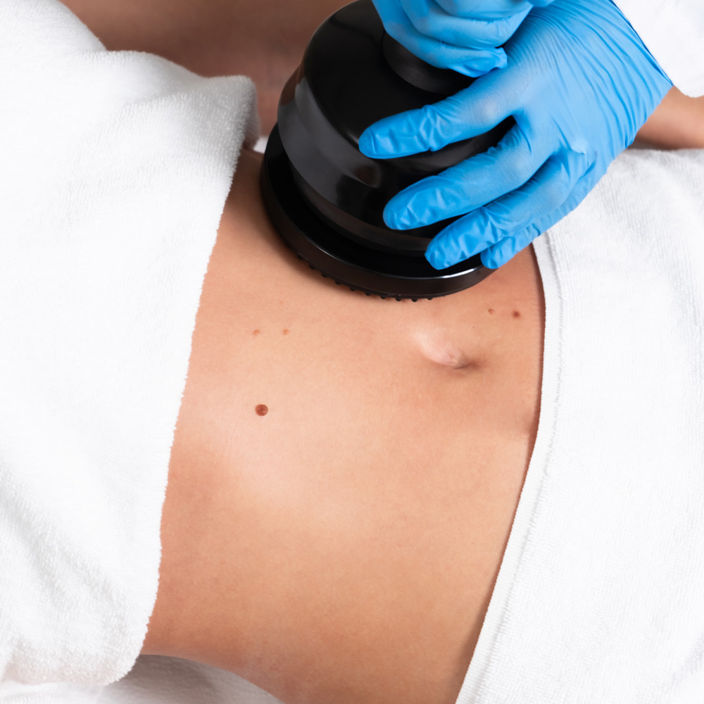 Ultrasound Skin Tightening: What to Expect After Treatment