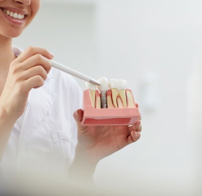 7 choses à savoir avant de recevoir des implants dentaires