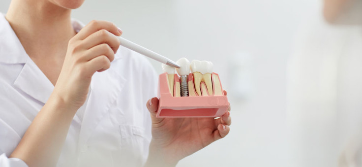 7 choses à savoir avant de recevoir des implants dentaires
