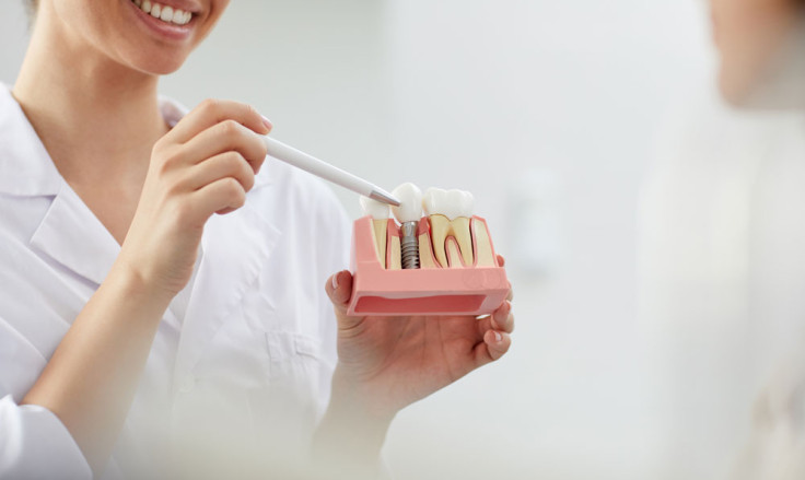 7 choses à savoir avant de recevoir des implants dentaires