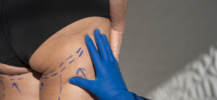 What Happens During an Inner Thigh Lift