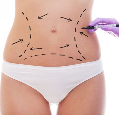 Abdominoplastie : 5 raisons d’opter pour cette chirurgie