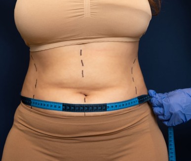 Abdominoplastia