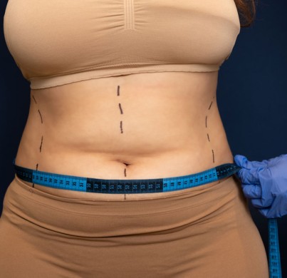Tummy Tuck