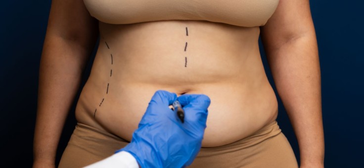 Les tarifs de l'abdominoplastie en Turquie