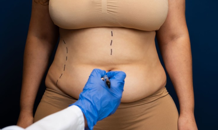 Tummy Tuck Cost in Turkey