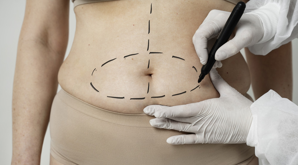 Full Tummy Tuck vs Mini Tummy Tuck