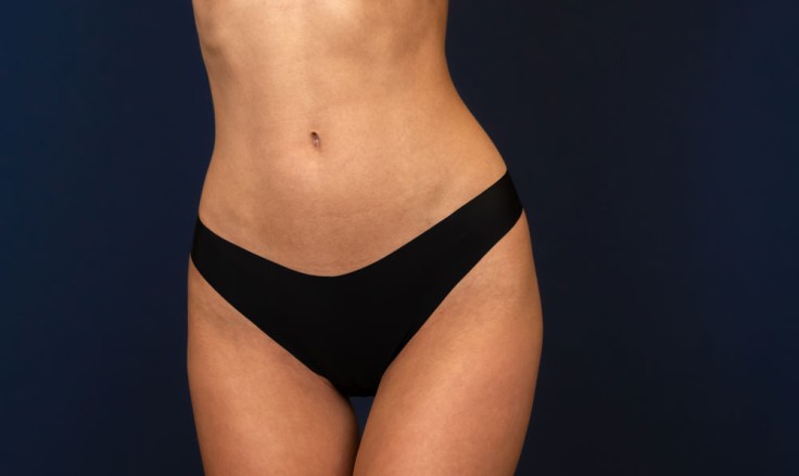 Modern Tummy Tuck Techniques for 2026