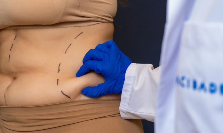 Tummy Tuck Surgery Procedure Steps in Turkey