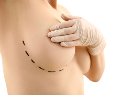 Types of Breast Implants: A Comprehensive Guide to Breast Augmentation   