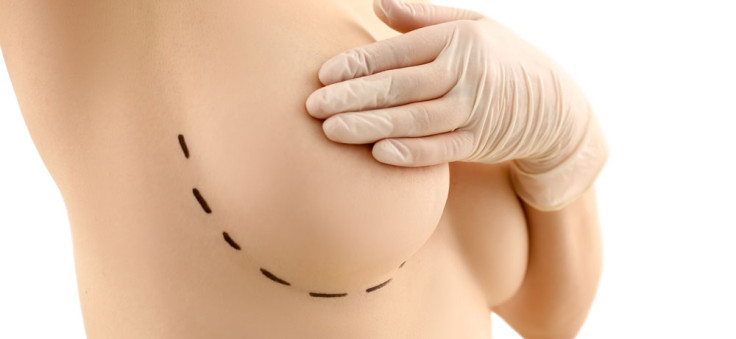 Types d’implants mammaires: Un guide complet sur l’augmentation mammaire