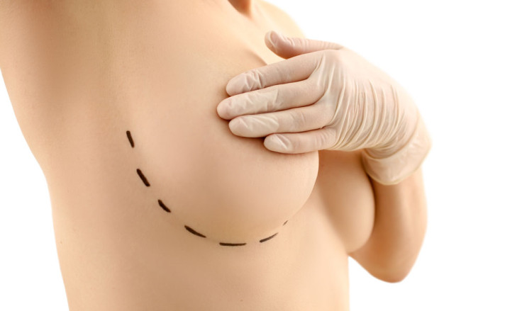 Arten von Brustimplantaten: Ein umfassender Leitfaden zur Brustvergrößerung   