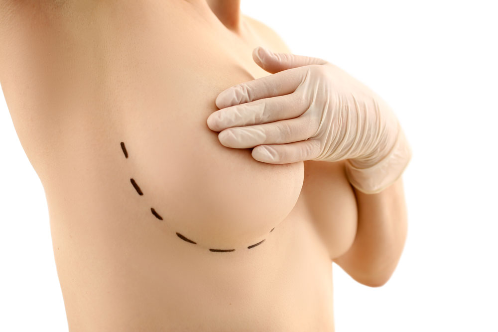 Types of Breast Implants: A Comprehensive Guide to Breast Augmentation