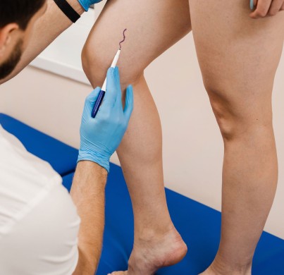 Varicose Vein Treatment in Turkey: Options and Cost