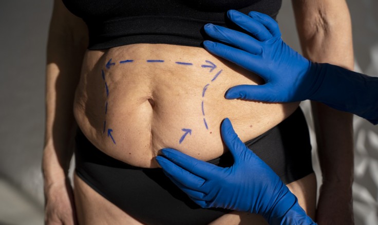 Combinación de liposucción con otros procedimientos