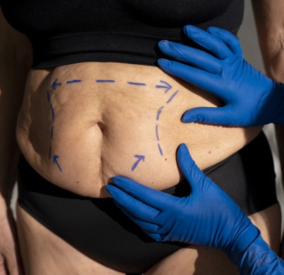 Un guide complet sur la liposuccion VASER
