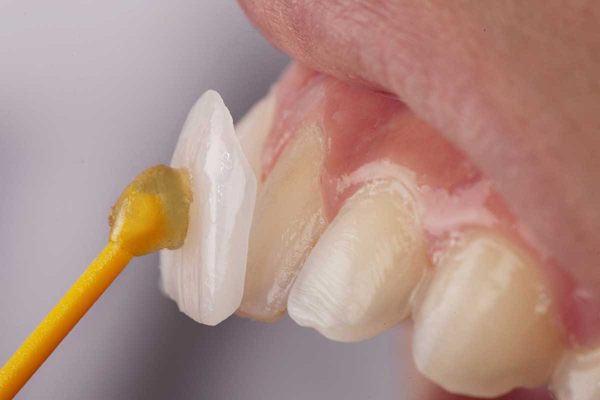 Faccette dentali estetiche: cosa sono e quando servono