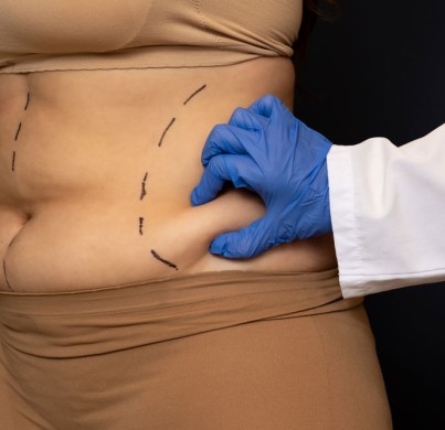 Liposuction