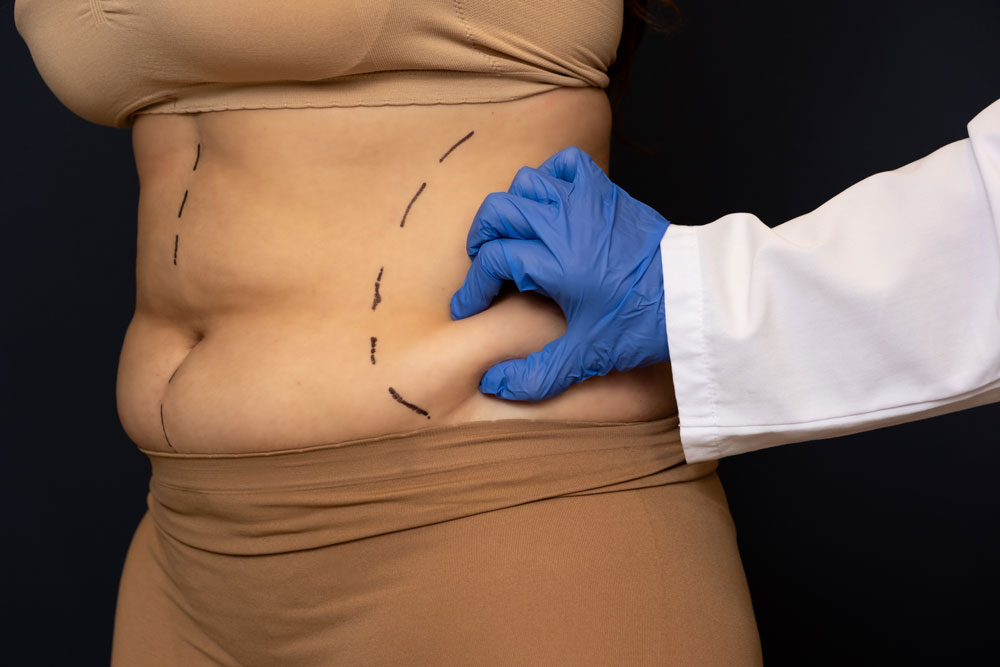 Liposuction