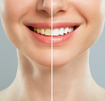 Can You Get Dental Veneers with Crooked Teeth?