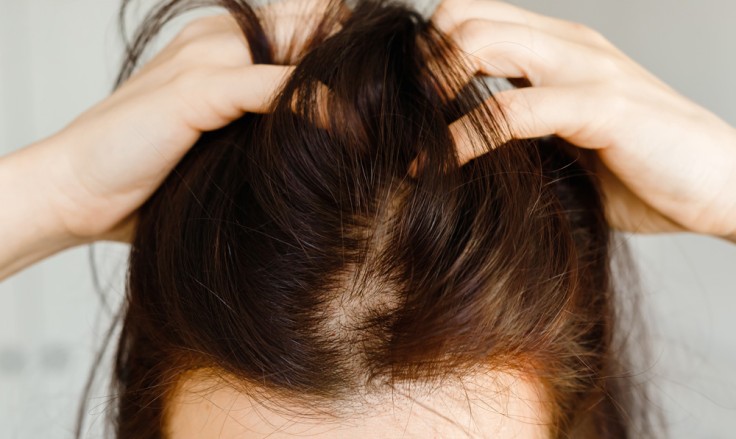 Hair Transplant for Women in Turkey: Types, Cost, Procedure