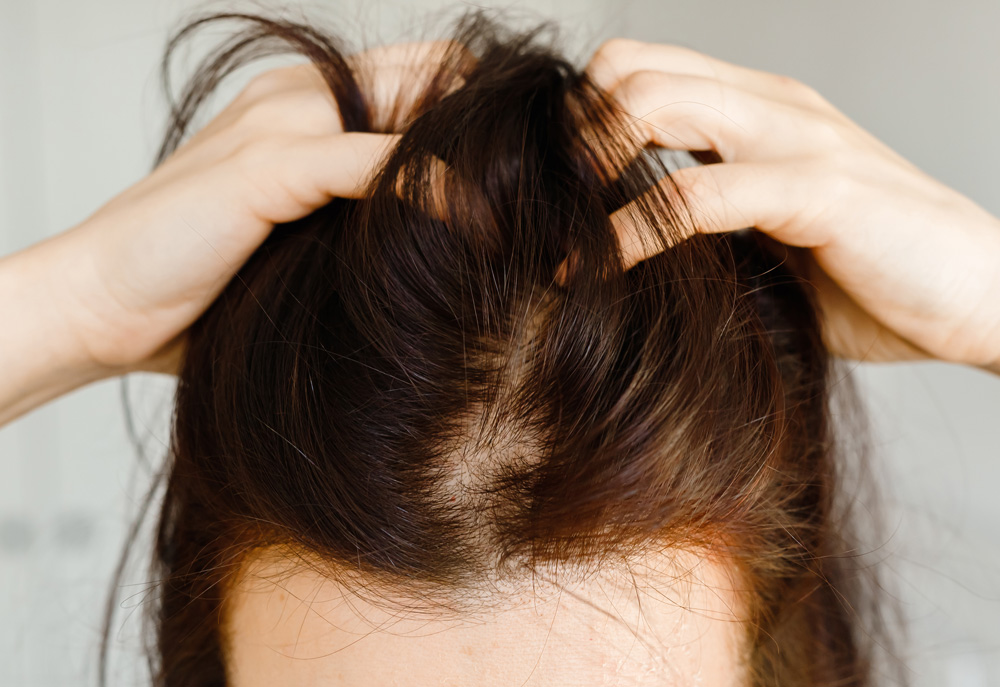 Does FUE Work for Women Too?
