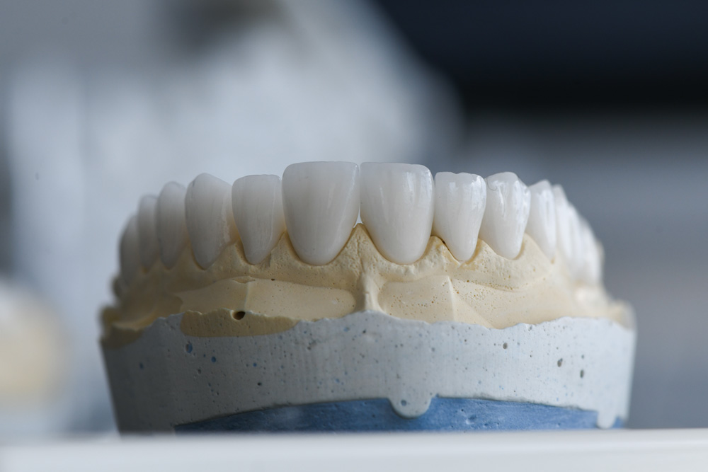 Zirconium Crowns Turkey: What to Expect, Procedure, Cost